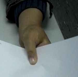 Hipoplasias do polegar 15 28