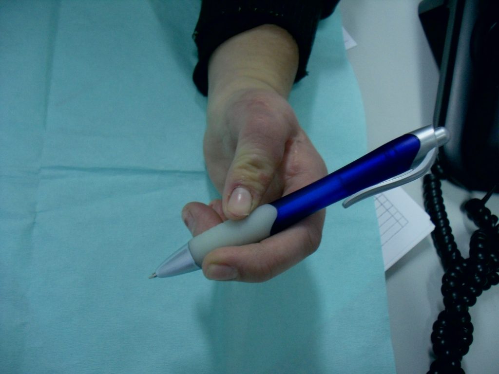 Hipoplasias do polegar 16 29