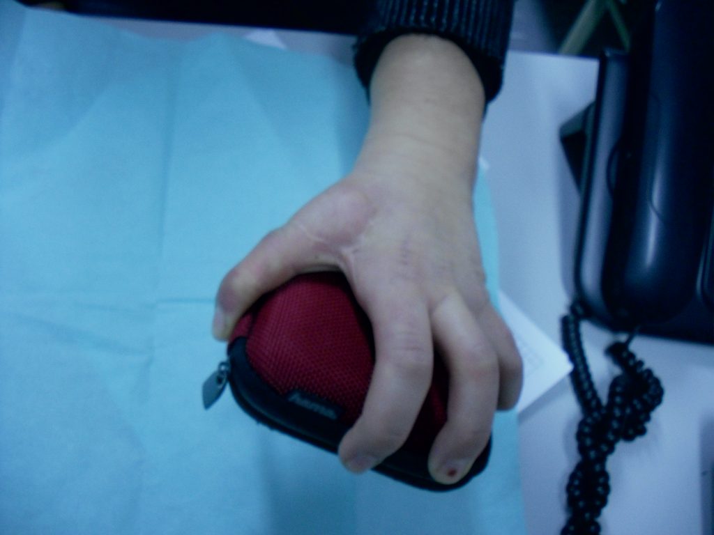 Hipoplasias do polegar 17 30