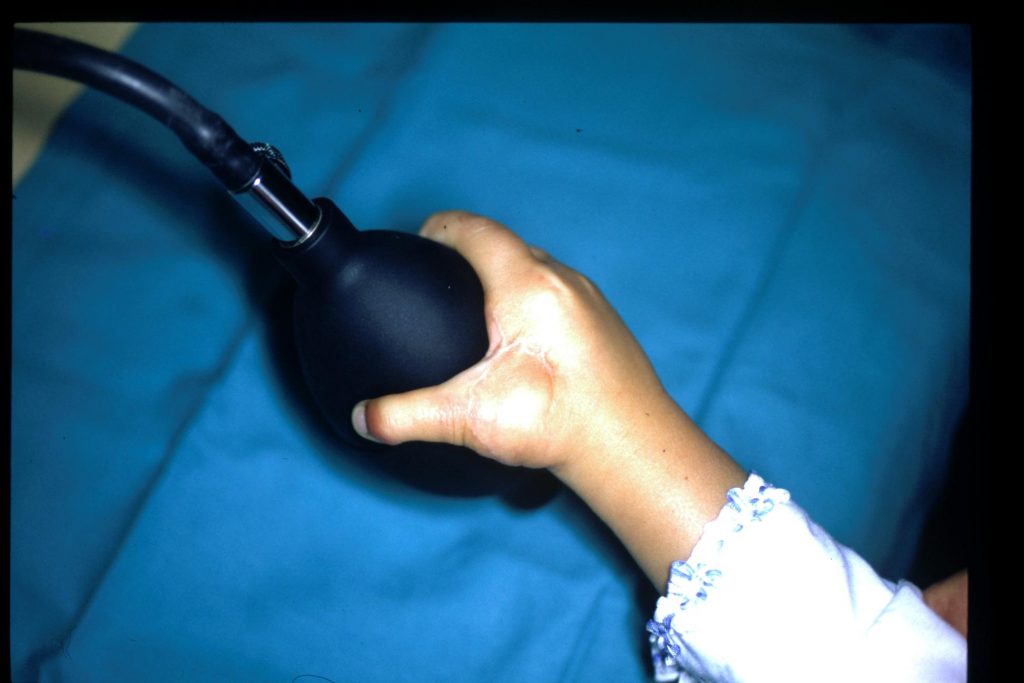 Hipoplasias do polegar 19 32