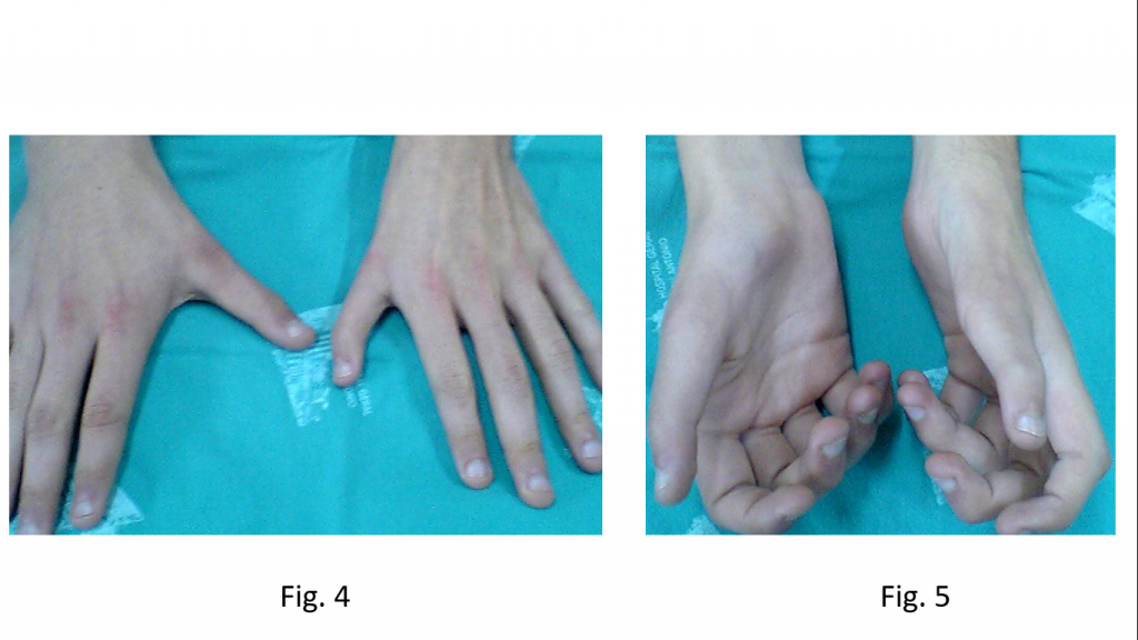 Hipoplasias do polegar 2 4 5