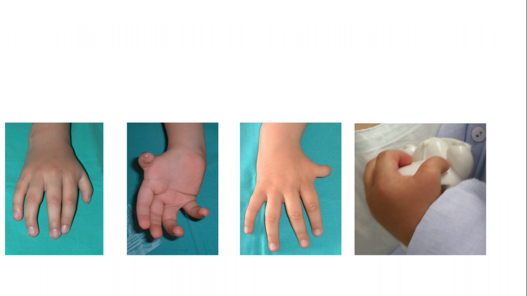 Hipoplasias do polegar 3 6 7 8 9